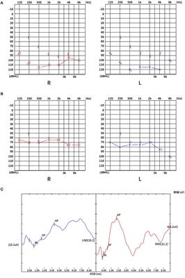 Case report: Bilateral sudden deafness in acute middle cerebellar peduncle infarction: central or peripheral?